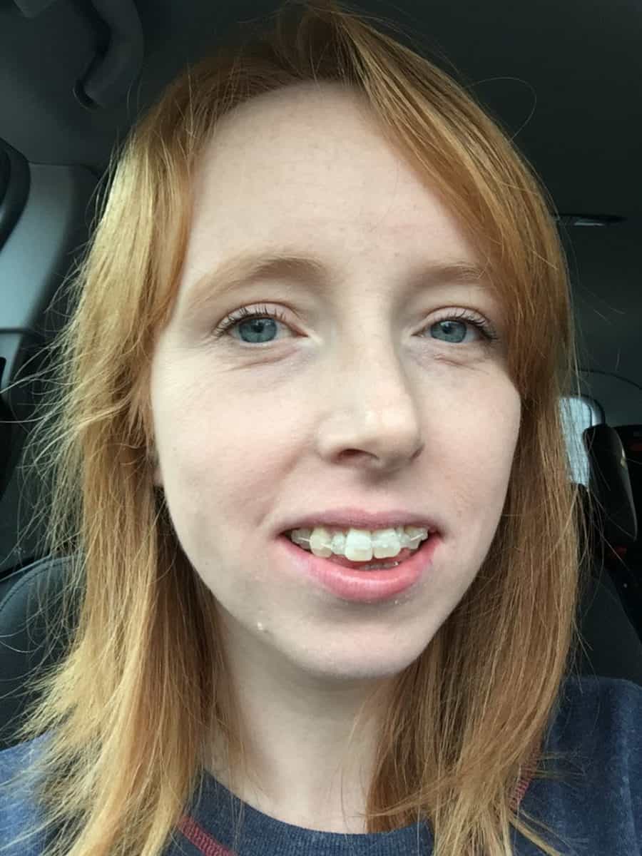 Redheads With Braces