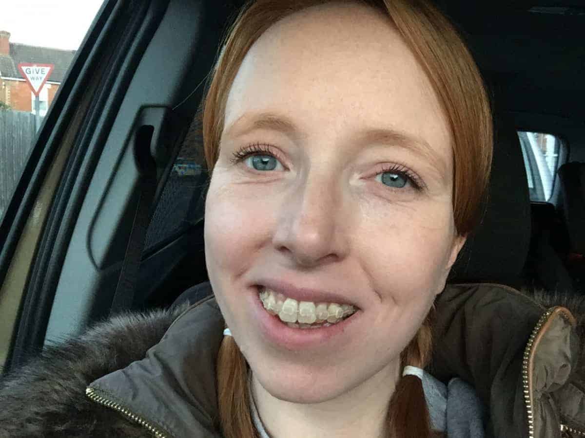 Getting my Teeth Straightened as an Adult - The End Results