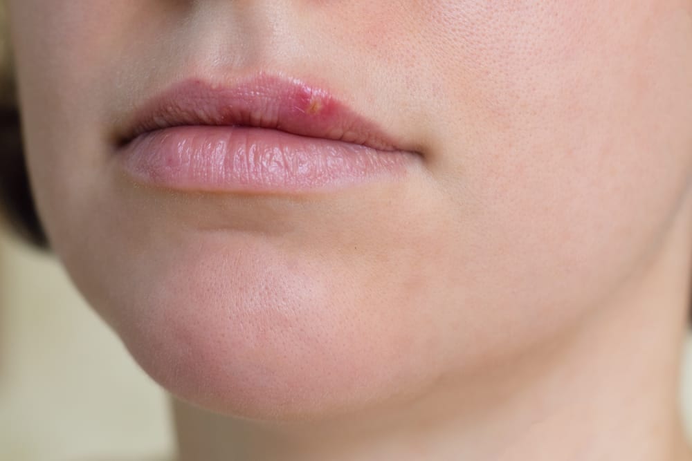 What Does Ringworm On Lips Look Like